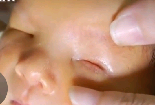 （图）女子生出无眼婴儿 医生:宝宝患无眼症 缺少眼球组织